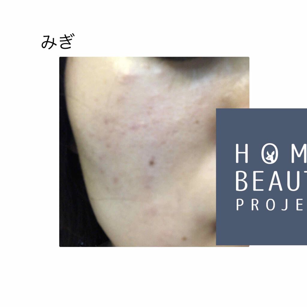 ミノン アミノモイスト 薬用アクネケア ローション/ミノン/化粧水を使ったクチコミ（2枚目）