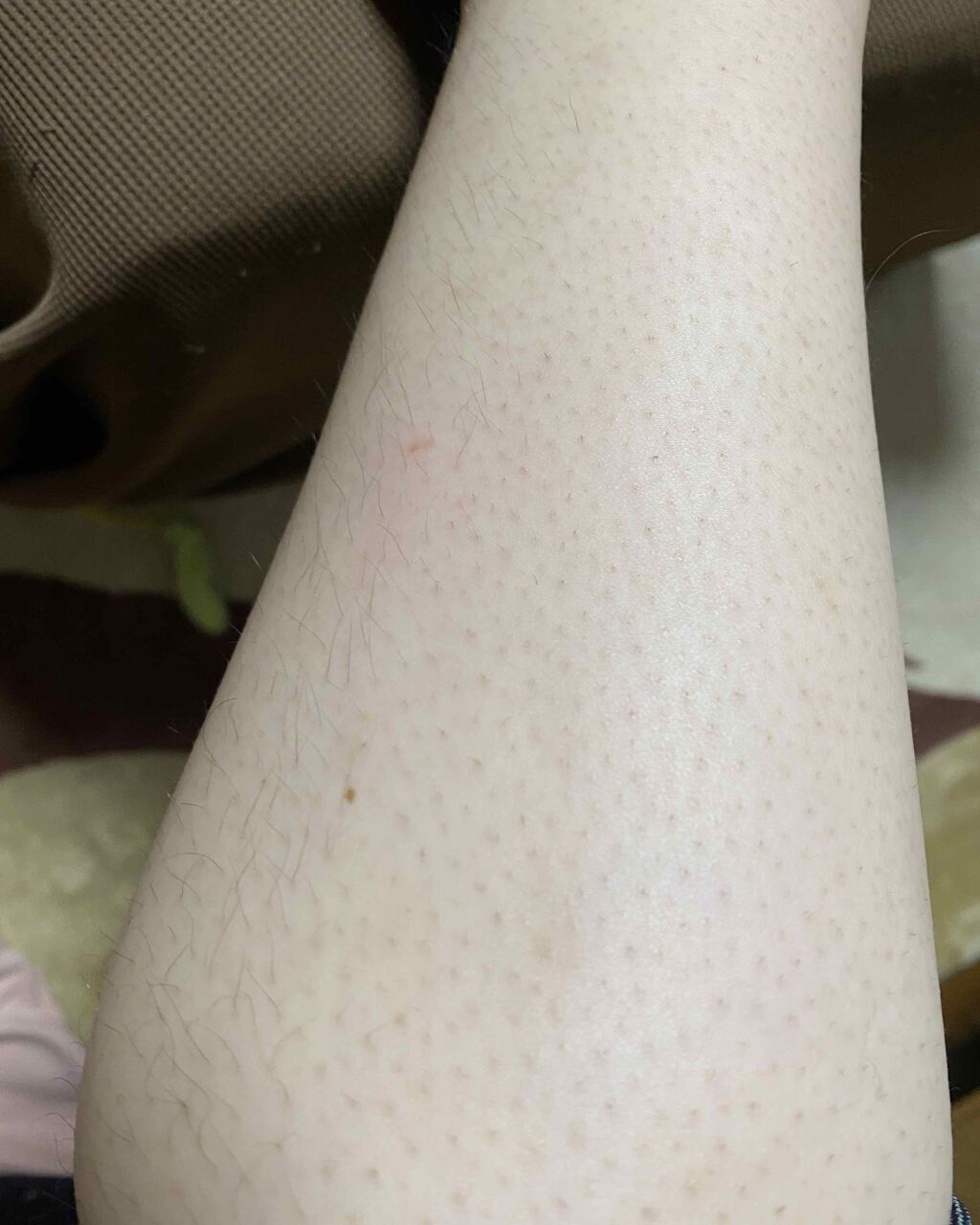 光脱毛器 VIO/Sarlisi/家庭用脱毛器を使ったクチコミ（3枚目）