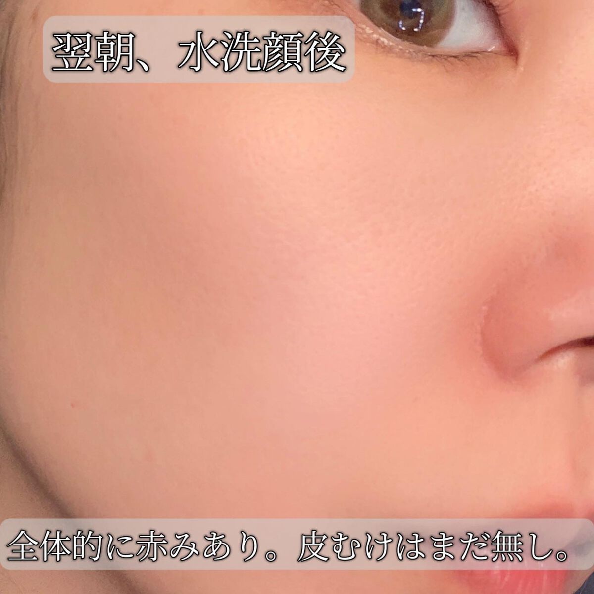 ダーマスキンピーリング/BQCELL/その他キットセットを使ったクチコミ(3枚目)