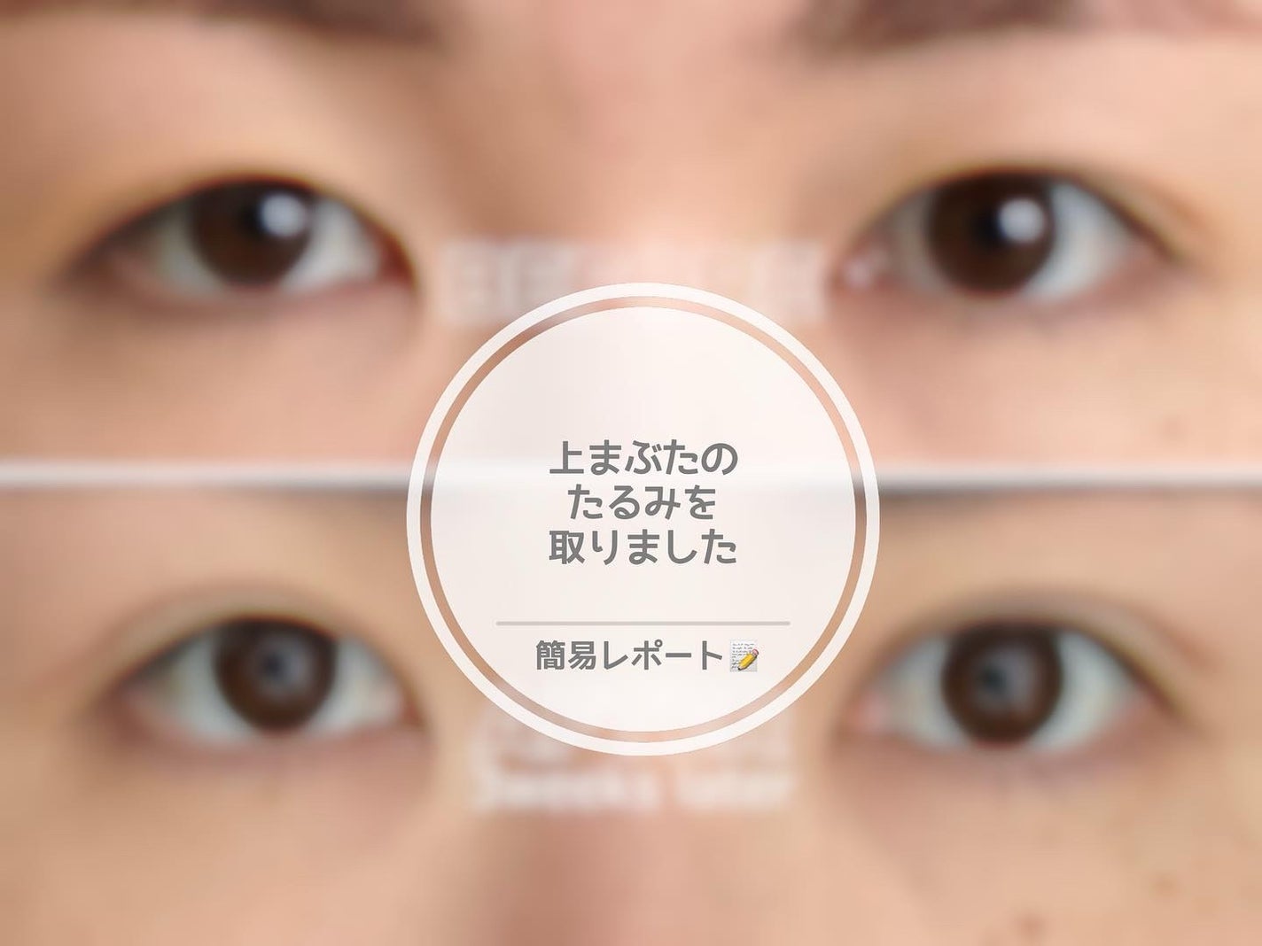 miyuki@PCアナリスト/コスメコンシェルジュ on LIPS 「実は!8月の上旬に上まぶたのたるみをとる手術を受けてきました✌..」(1枚目)