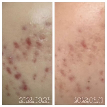 ニキビあとケアジェル/アットノン/その他スキンケアを使ったクチコミ(3枚目)