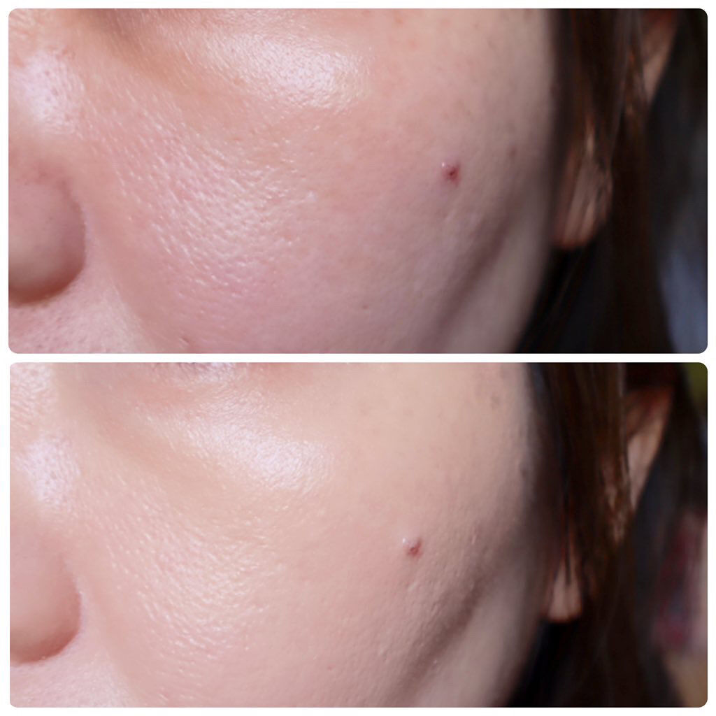 ピンクティーツリーカバークッション/APLIN/クッションファンデーションを使ったクチコミ（3枚目）