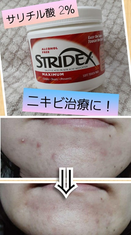 1ステップ ニキビコントロール マキシマム/STRIDEX/ピーリングを使ったクチコミ(1枚目)