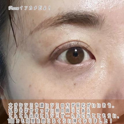 ちっちみ on LIPS 「🪿シミ取りレポ新宿三丁目からすぐのオーロラクリニック新宿院でピ..」(4枚目)