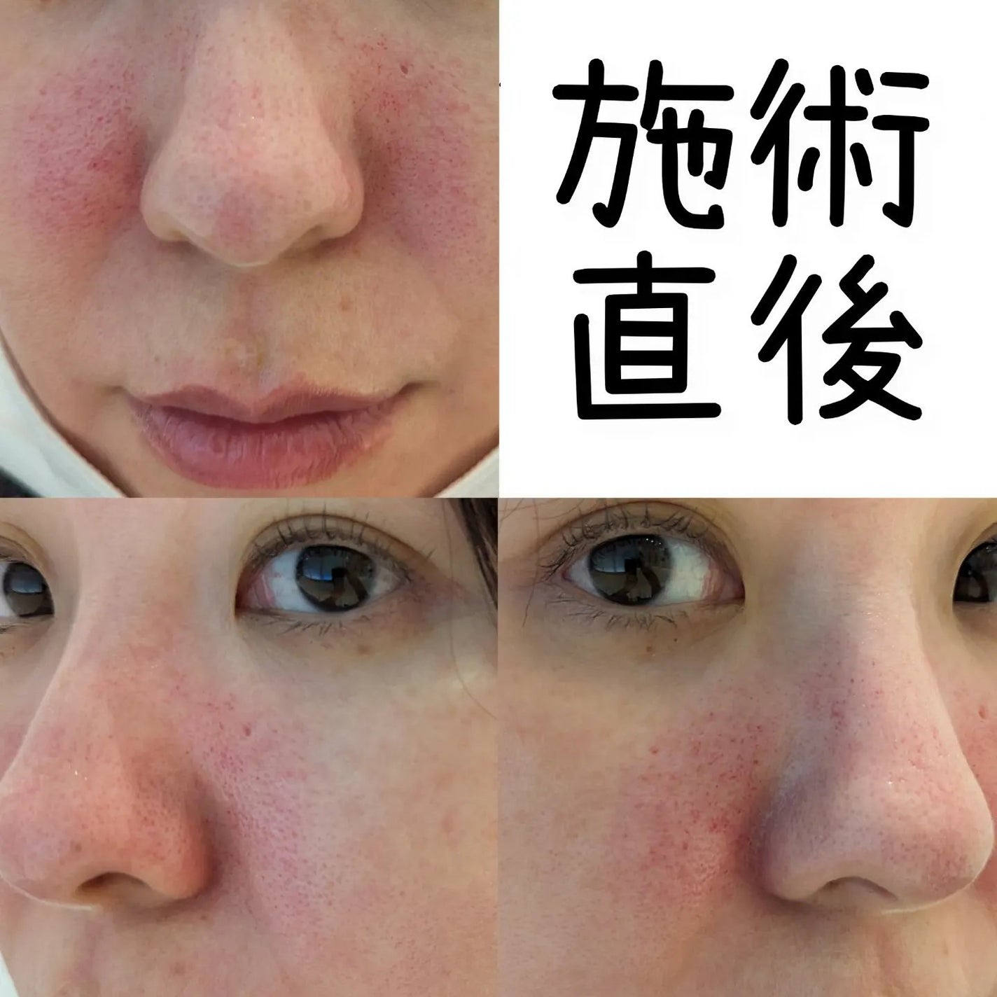 ゆなcc:フォロバ100 on LIPS 「今回は、いつものメンテナンスにピコフラクショナルを追加しました..」(2枚目)