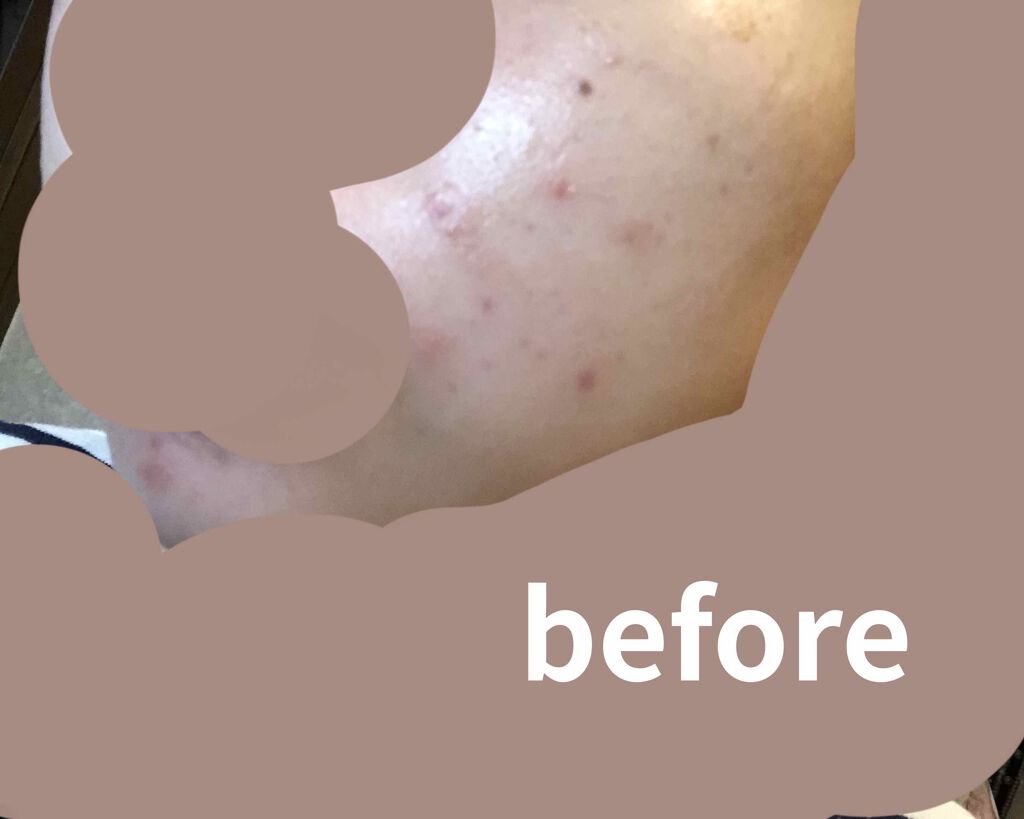 ベピオゲル/マルホ株式会社/その他を使ったクチコミ（2枚目）