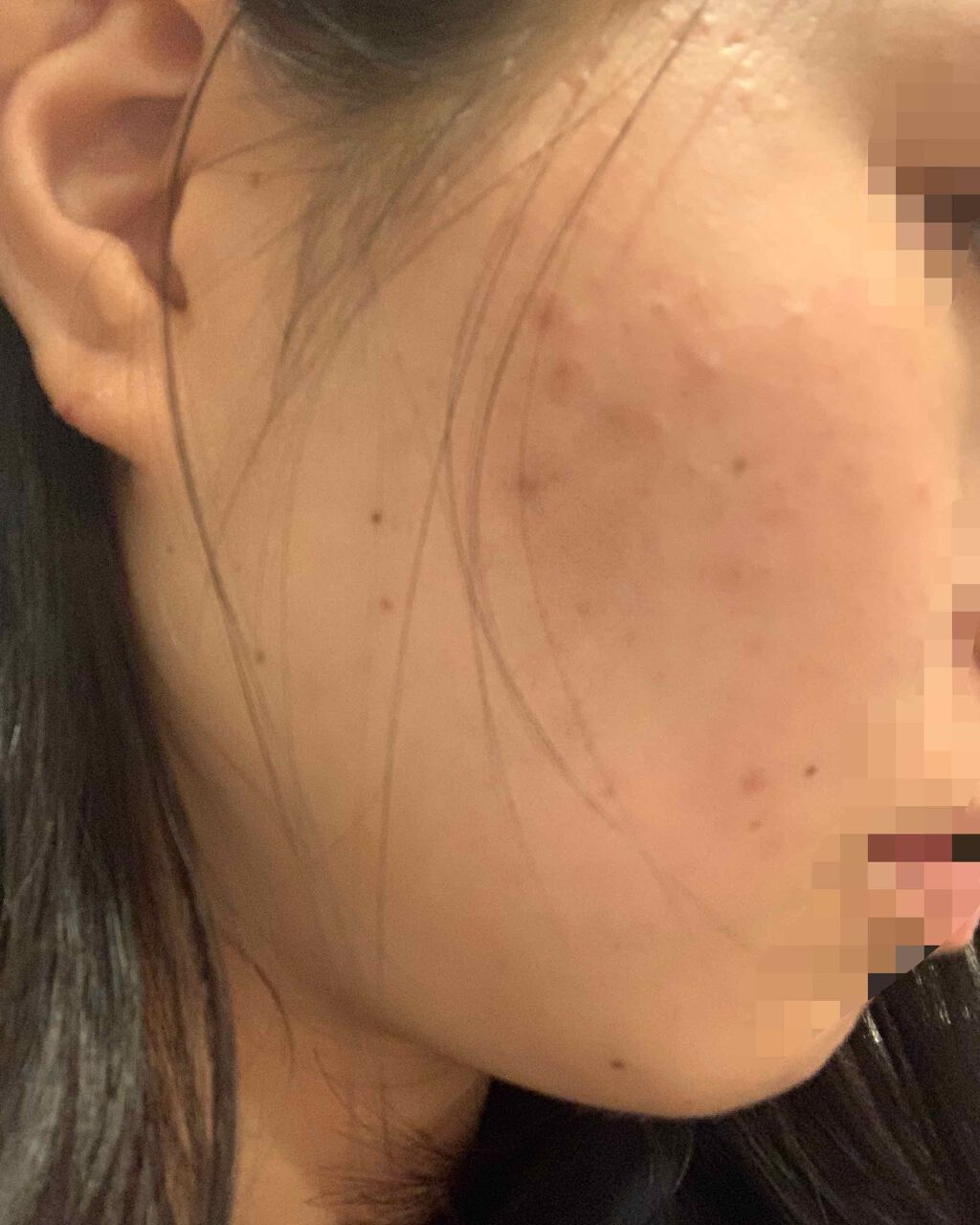 もも on LIPS 「肌荒れをほんきでなおすぞ!part1初投稿です。2枚目注意!肌..」(2枚目)