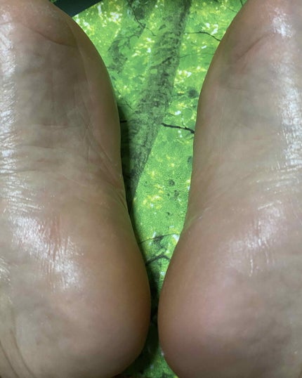 足用集中保湿パック/ドクター・ショール/レッグ・フットケアを使ったクチコミ(7枚目)