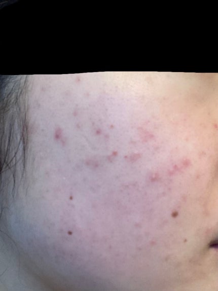 ハトムギ化粧水(ナチュリエ スキンコンディショナー R )/ナチュリエ/化粧水を使ったクチコミ(2枚目)