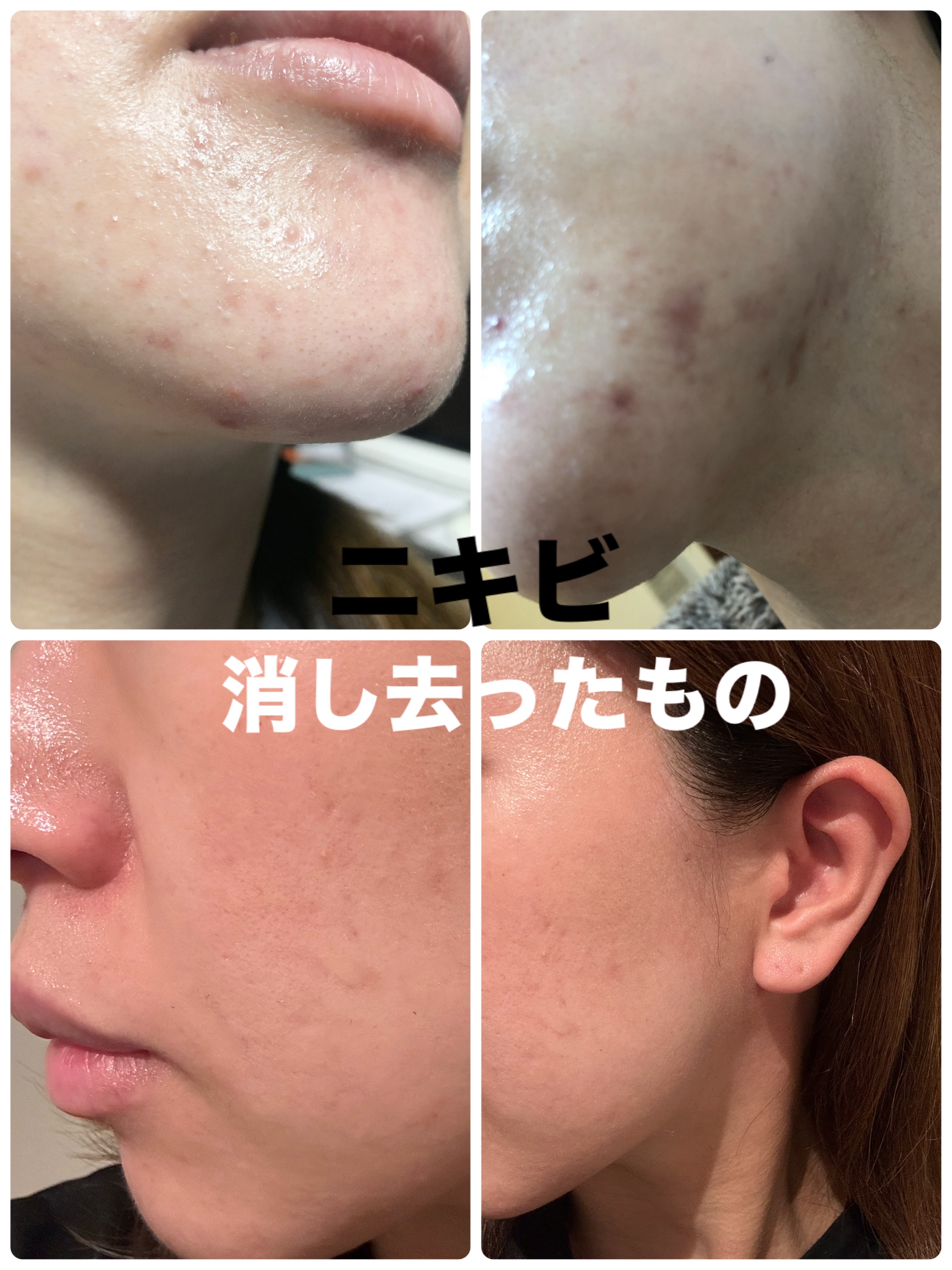 スキンピールバー AHA/サンソリット/洗顔石鹸を使ったクチコミ（1枚目）