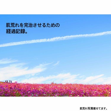 肌荒れ経過記録。

大っきいポツポツは消えたかな？？
まだ赤みと小さなニキビが😭

よく肌荒れは皮膚科が1番と言いますが
薬に負けやすい私はニキビ用の薬で顔が全部
かぶれました。
今は効果は低いですが自