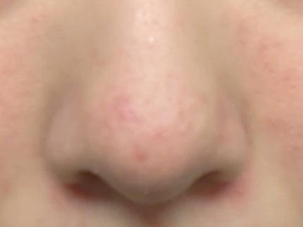 鼻 バブルパック/CNP Laboratory/シートマスク・パックを使ったクチコミ(2枚目)