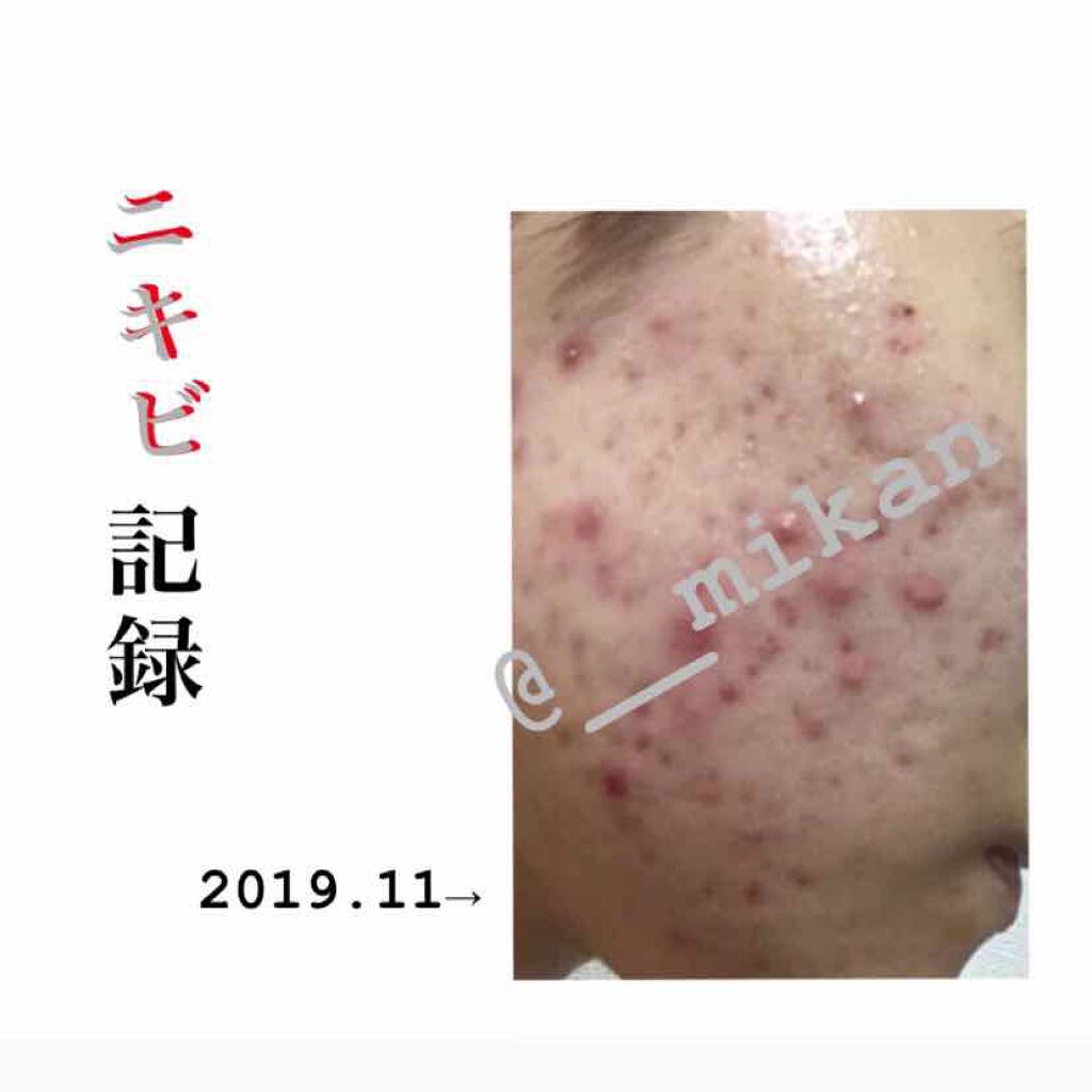 モイスチャークリーム2/エンビロン/フェイスクリームを使ったクチコミ(1枚目)