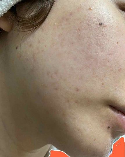 A アクネフォーム/NOV/洗顔フォームを使ったクチコミ(4枚目)