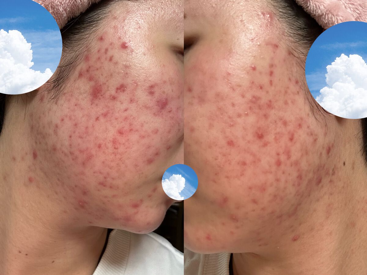 ピンクティーツリークリーム/APLIN/フェイスクリームを使ったクチコミ（1枚目）