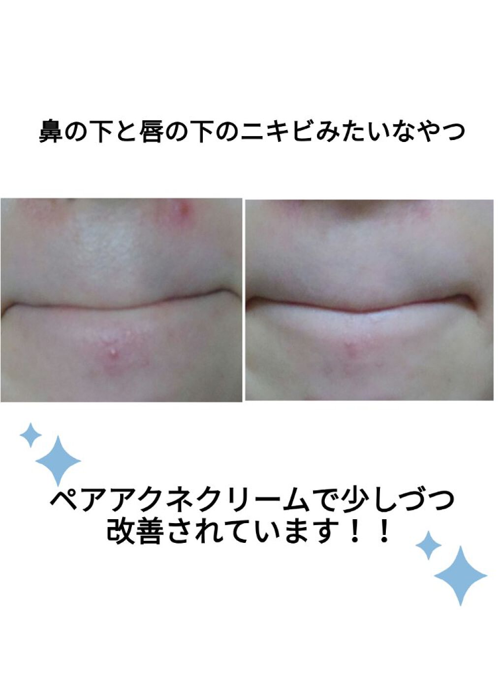 ペアアクネクリームW(医薬品)/ペア/その他を使ったクチコミ（1枚目）