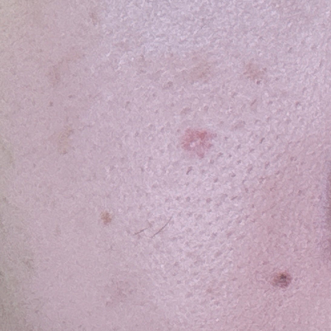 薬用コンシーラー アクネプロテクター/ONLY MINERALS/パウダーコンシーラーを使ったクチコミ(4枚目)