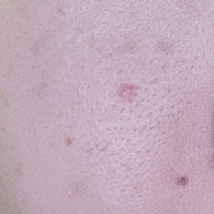 薬用コンシーラー アクネプロテクター/ONLY MINERALS/パウダーコンシーラーを使ったクチコミ(4枚目)