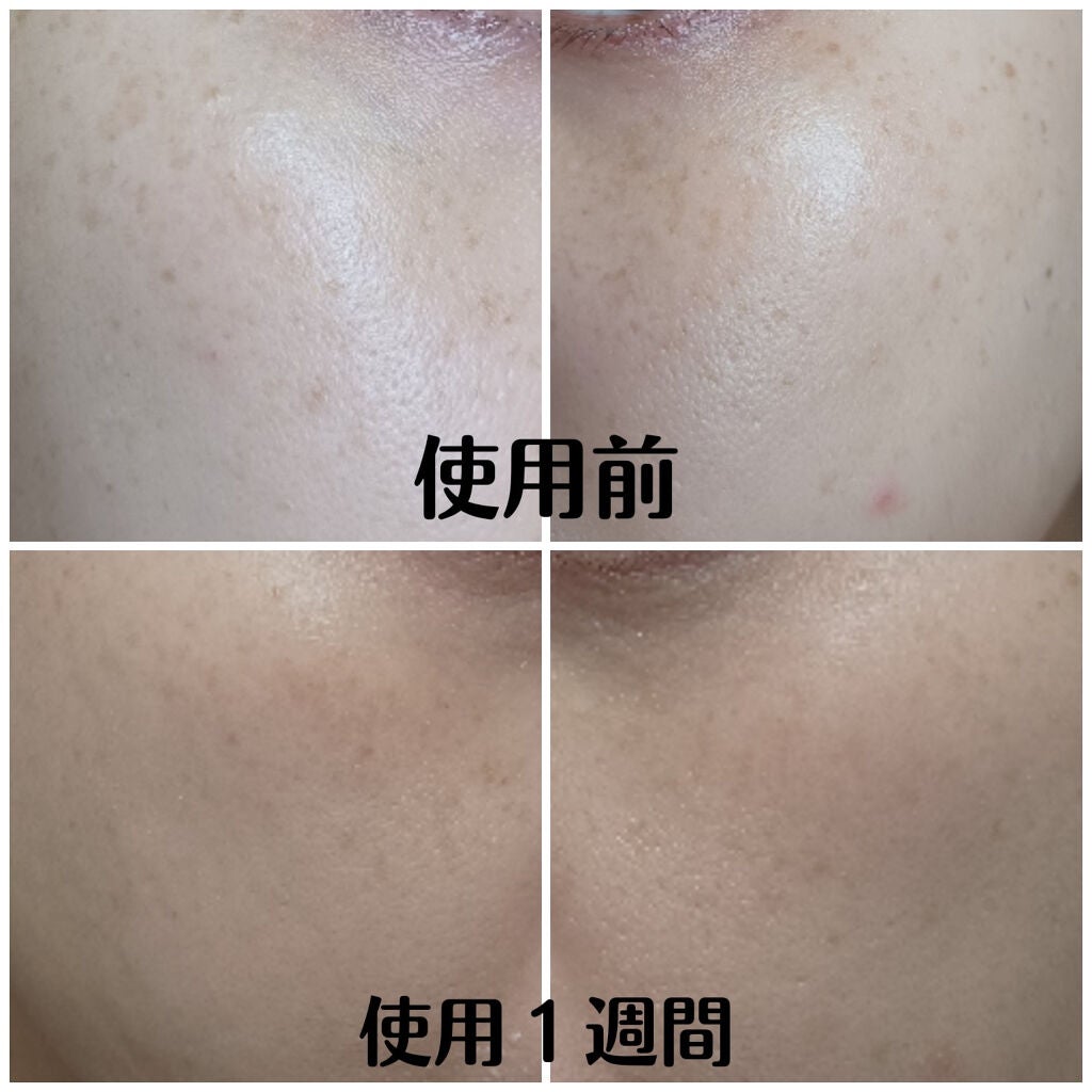 バブ美 on LIPS 「ゼオスキンのセラピューティックを始めて1週間目の様子です。朝:..」(2枚目)