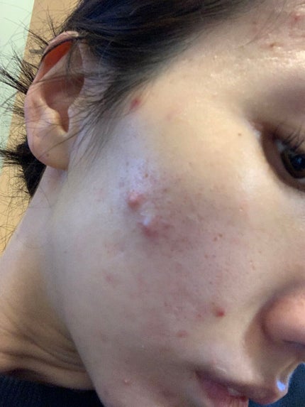 オードムーゲ 薬用ローション(ふきとり化粧水)/オードムーゲ/拭き取り化粧水を使ったクチコミ(1枚目)