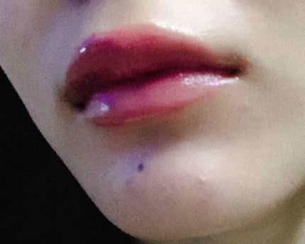 エピデュオゲル/マルホ株式会社/その他を使ったクチコミ(1枚目)