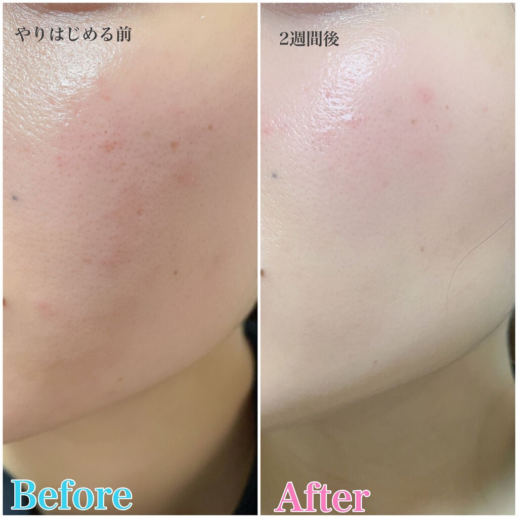 ごんす@YouTube始めました on LIPS 「《ELFACE》昨日YouTube動画でやったやつ、♥️美容大..」(5枚目)