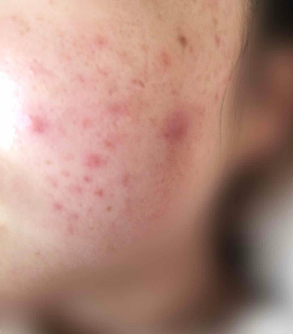 shiny_blush_azhu on LIPS 「⚠️閲覧注意です。病院に何回か行き薬をもらっても効き目が全くな..」(2枚目)