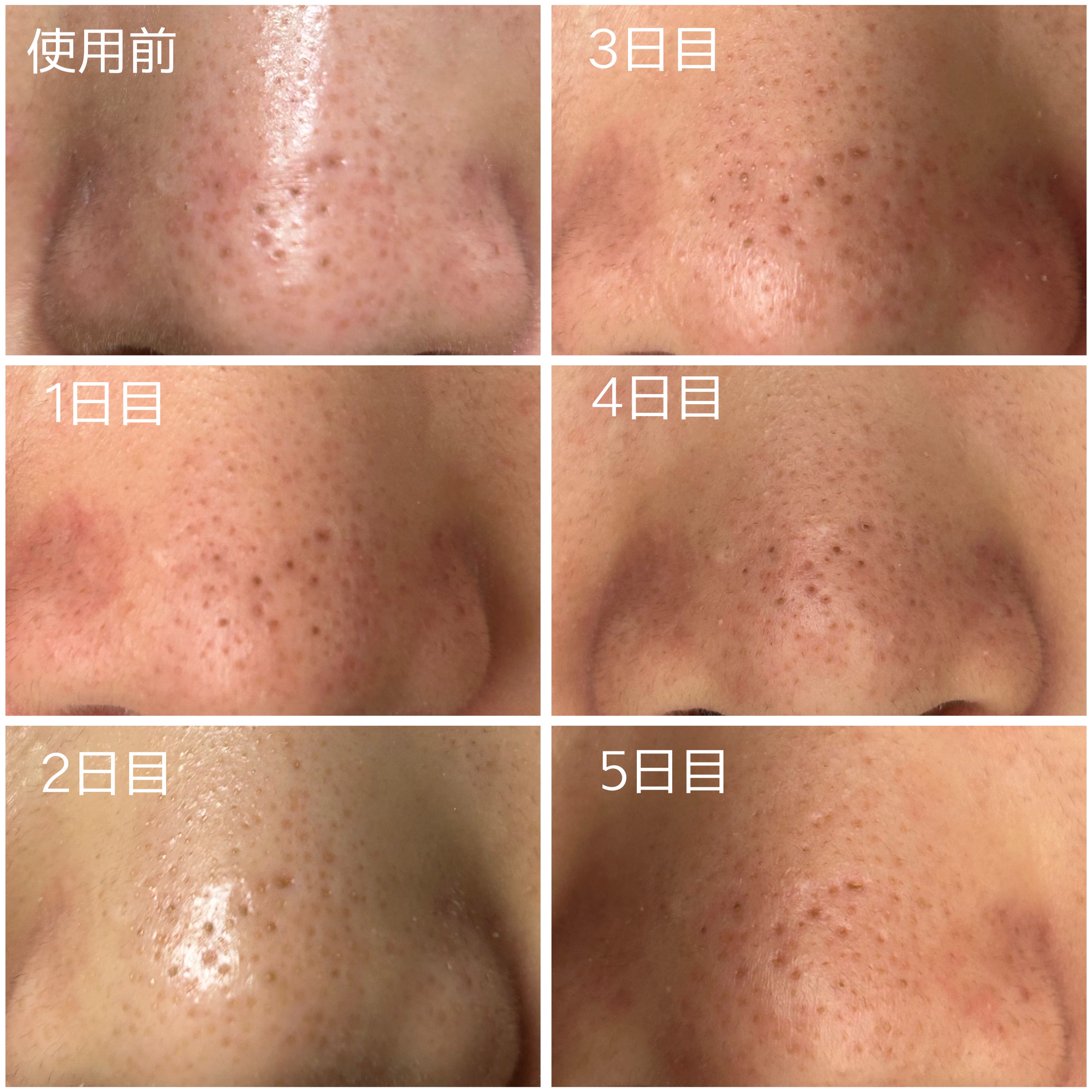 毛穴アンプル/ブラン/美容液を使ったクチコミ（2枚目）