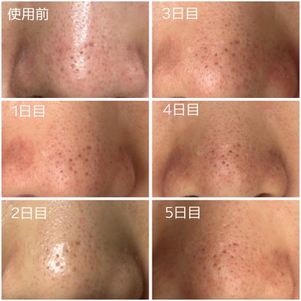 毛穴アンプル/ブラン/美容液を使ったクチコミ(2枚目)