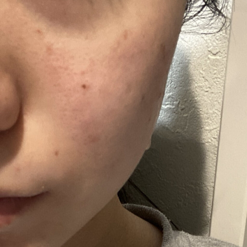 薬用しみ対策 美白化粧水/メラノCC/化粧水を使ったクチコミ（3枚目）