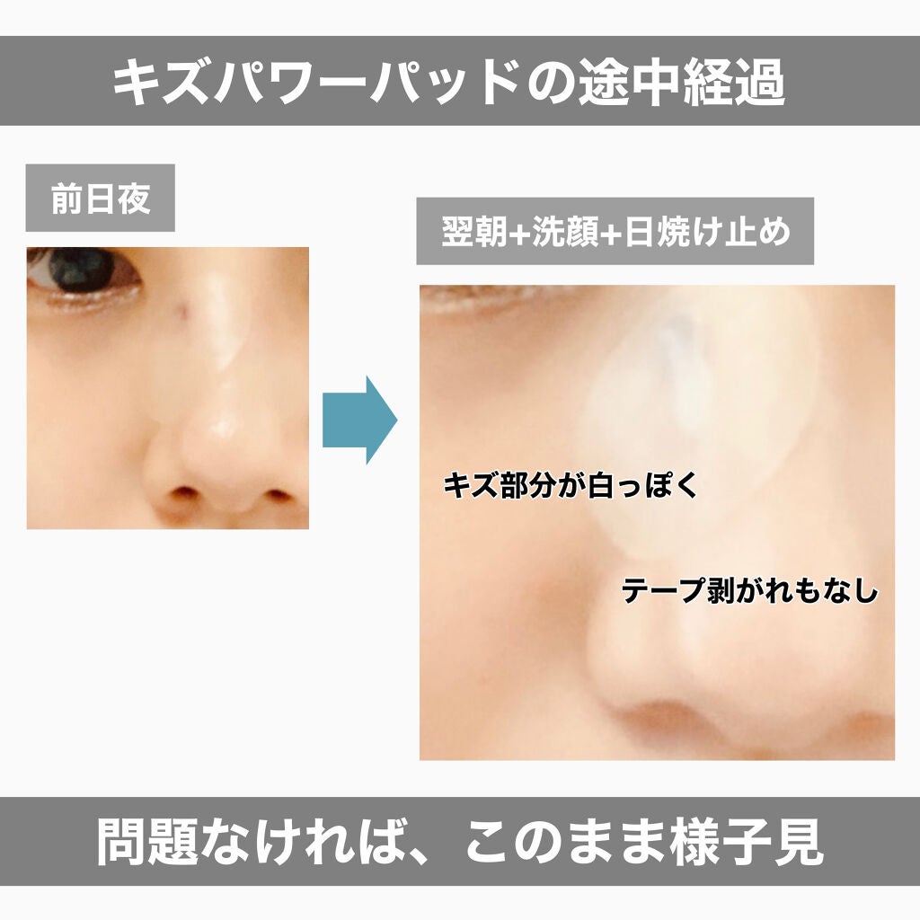 キズパワーパッド/バンドエイド/その他を使ったクチコミ(2枚目)