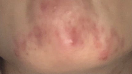 オードムーゲ 薬用ローション(ふきとり化粧水)/オードムーゲ/拭き取り化粧水を使ったクチコミ(3枚目)