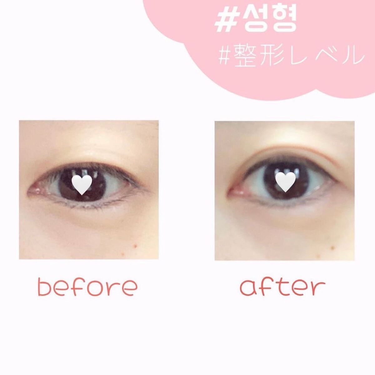 ダブルグルー 接着タイプ/メザイク/二重まぶた用アイテムを使ったクチコミ（2枚目）