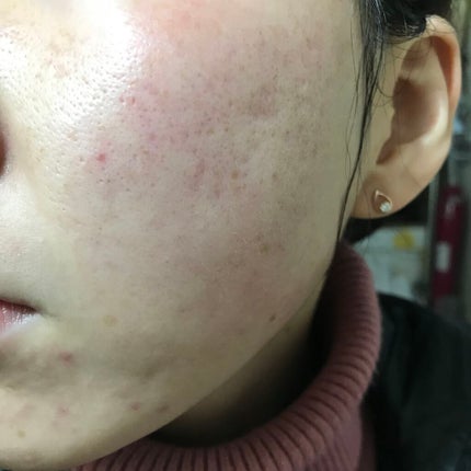 レチノールA 1% アドバンスドリバイタリゼーションクリーム/Life-flo/フェイスクリームを使ったクチコミ(2枚目)