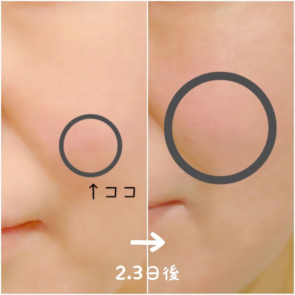 ゼロスポットシカクリーム/Today’s Cosme/フェイスクリームを使ったクチコミ(4枚目)