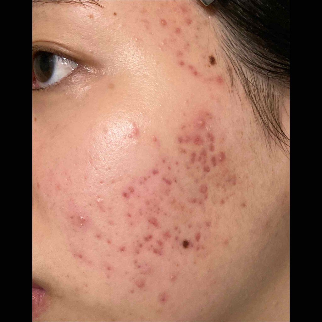 ディフェリンゲル0.1% /マルホ株式会社/その他を使ったクチコミ（1枚目）