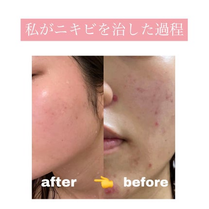 薬用 クリアローション M(しっとりタイプ)/オルビス/化粧水を使ったクチコミ(1枚目)