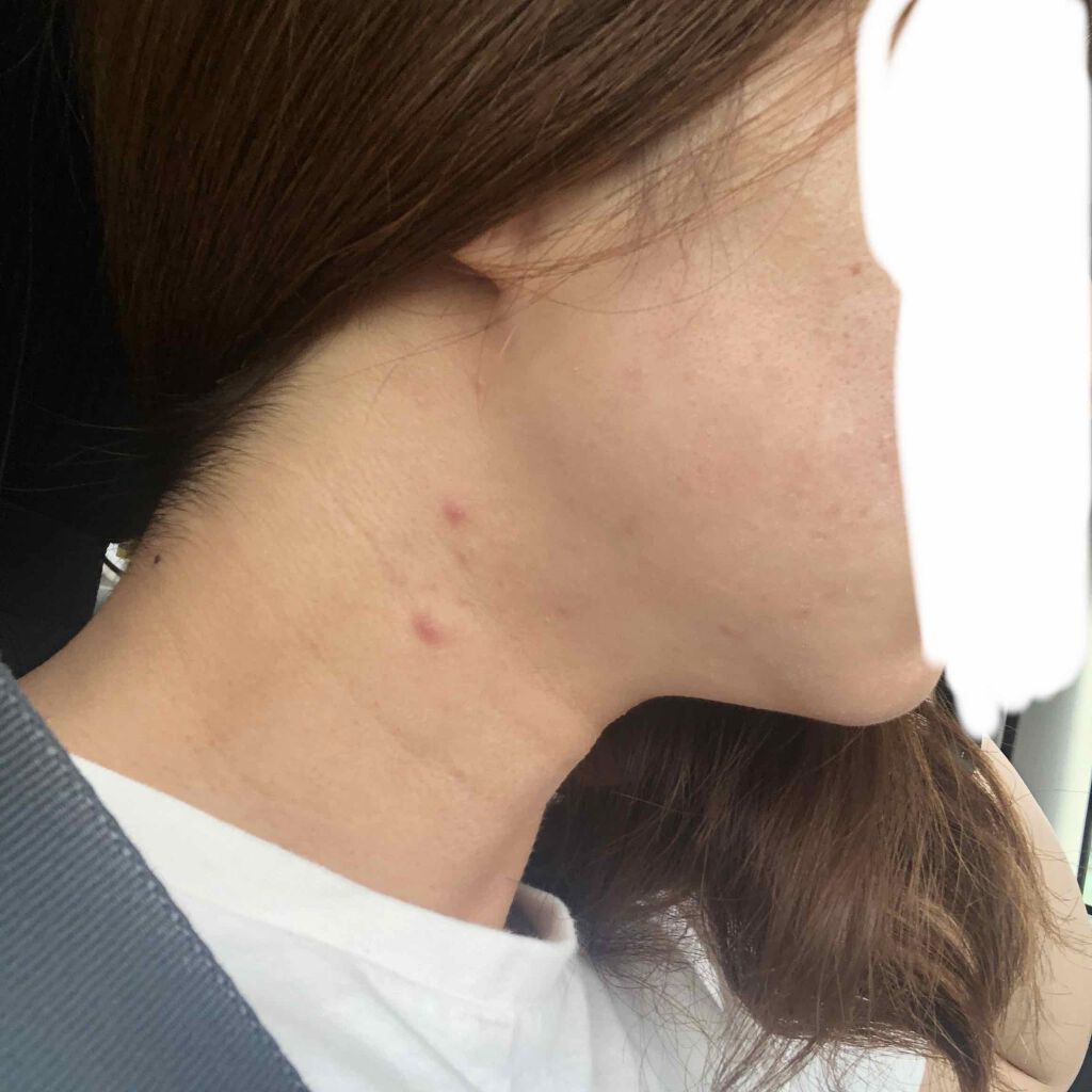 ペアアクネクリームW(医薬品)/ペア/その他を使ったクチコミ(1枚目)