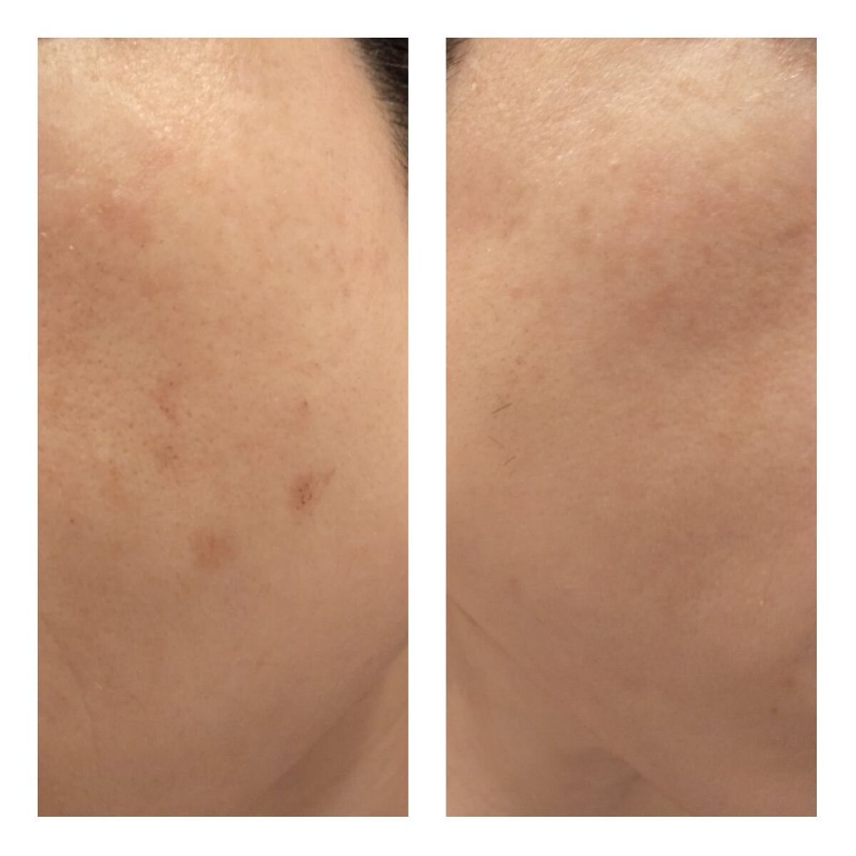 あにゃにゃ♡フォロバ100♡ on LIPS 「11/12に4回目のフォトシルクプラス(シミ取り)を受けてきま..」(5枚目)