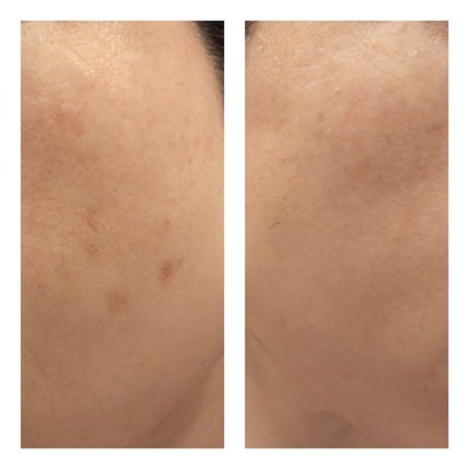 あにゃにゃ♡フォロバ100♡ on LIPS 「11/12に4回目のフォトシルクプラス(シミ取り)を受けてきま..」(5枚目)