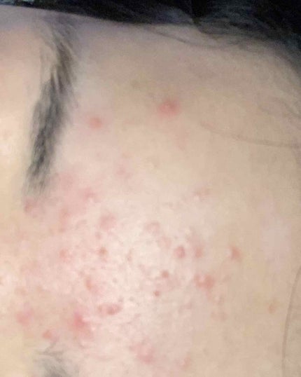 おからちゃん on LIPS 「2枚目から閲覧注意!!緊急事態です。もう全然治らないこのニキビ..」(4枚目)