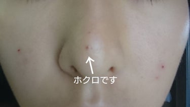 毛穴撫子 重曹泡洗顔のクチコミ「ニキビ&毛穴撲滅！肌日記私も始めます！
まずは今の肌の状態。

ニキビもあり頬の毛穴もポツポツ.....」（2枚目）