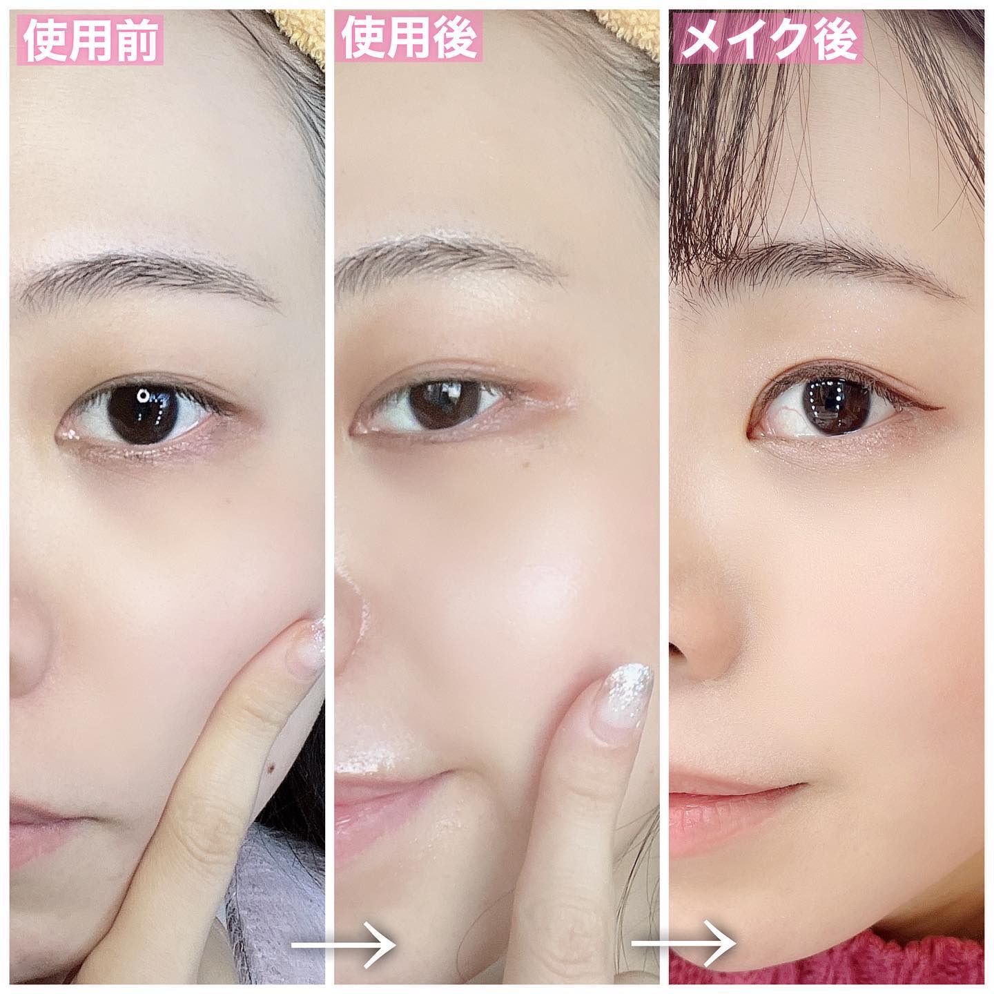 アトピー安心マーク獲得 プラビュー 美顔器セット 肌トラブルケア 敏感肌ケア アトピー安心マーク獲得 プラビュー 美顔器セット 肌トラブル