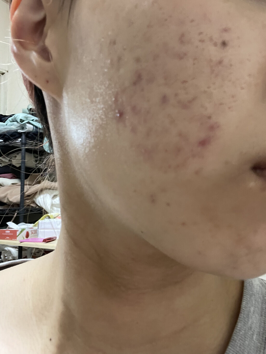 ニキビあとケアジェル/アットノン/その他スキンケアを使ったクチコミ（2枚目）