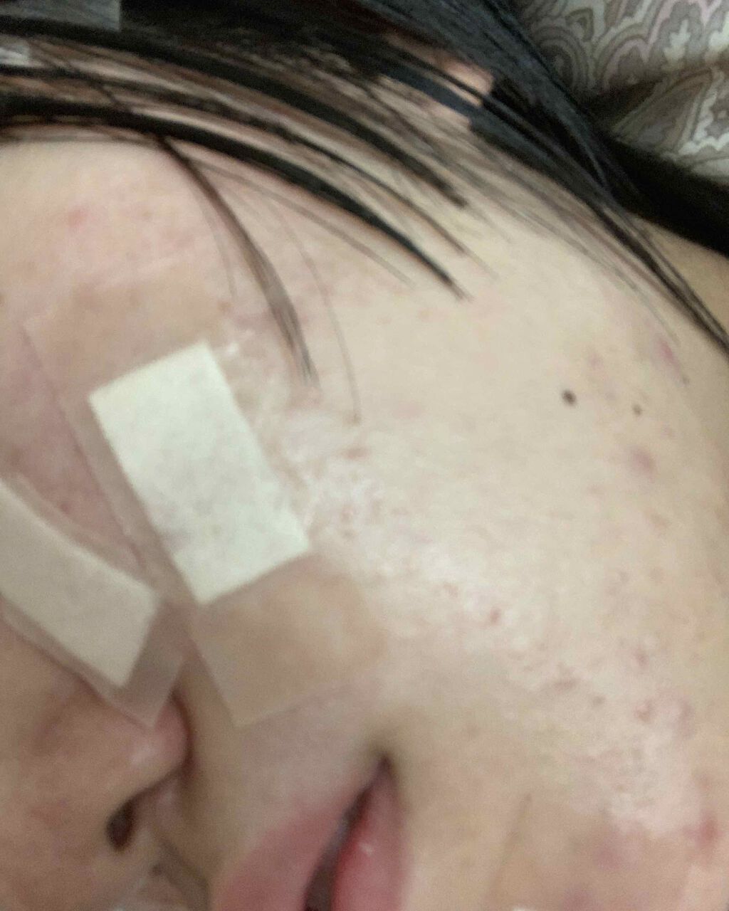 あああ on LIPS 「ほんとにニキビが治らない。もうすっごいしんどい。なんかいい方法..」(1枚目)