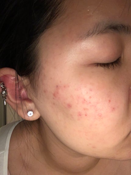 ティーツリーケア ソリューション エッセンシャルマスクEX/MEDIHEAL/シートマスク・パックを使ったクチコミ(2枚目)