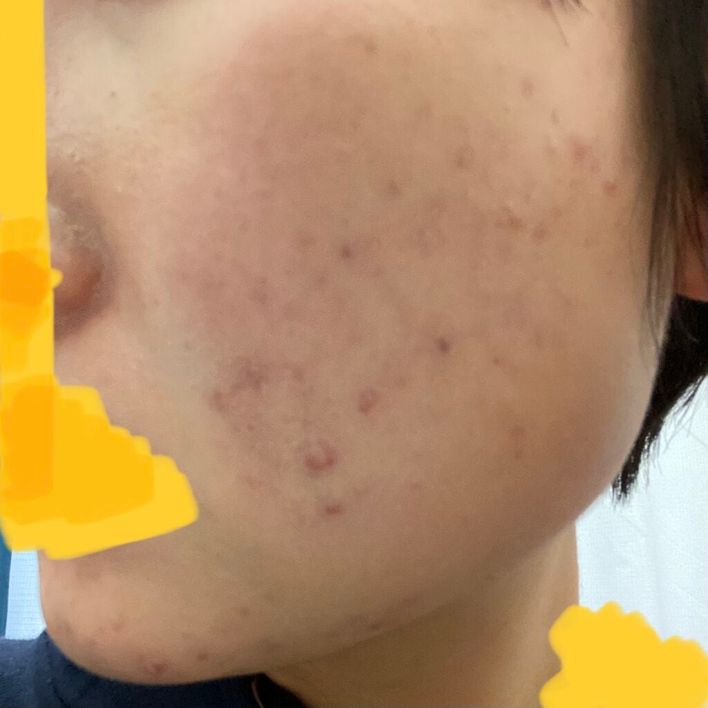 24 ミネラルスティックファンデ/24h cosme/その他ファンデーションを使ったクチコミ(5枚目)