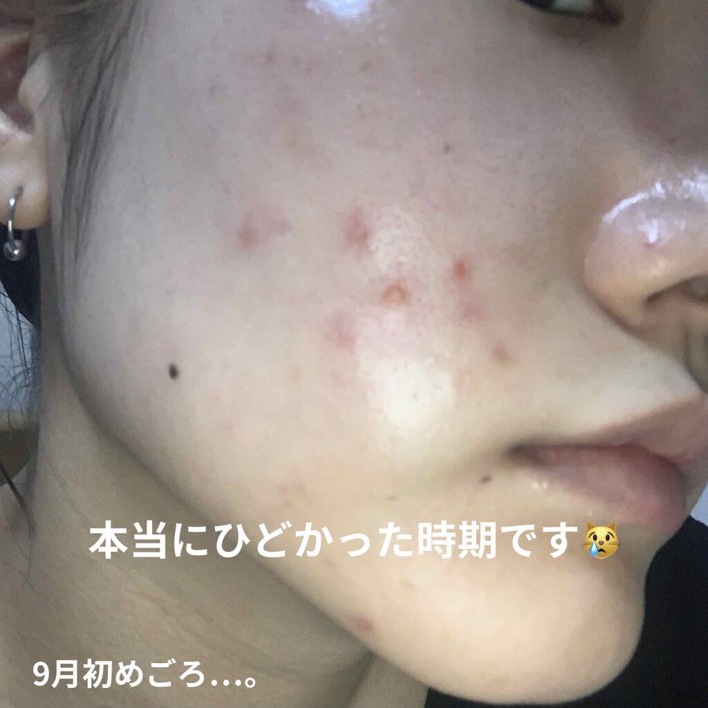 ペアアクネクリームW(医薬品)/ペア/その他を使ったクチコミ（3枚目）