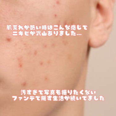 メンソレータム アクネス 薬用ふわふわな泡洗顔のクチコミ「ニキビに悩んでるならこの洗顔を買え

プチプラなのに効果抜群！

今までニキビに効く洗顔使って.....」（2枚目）