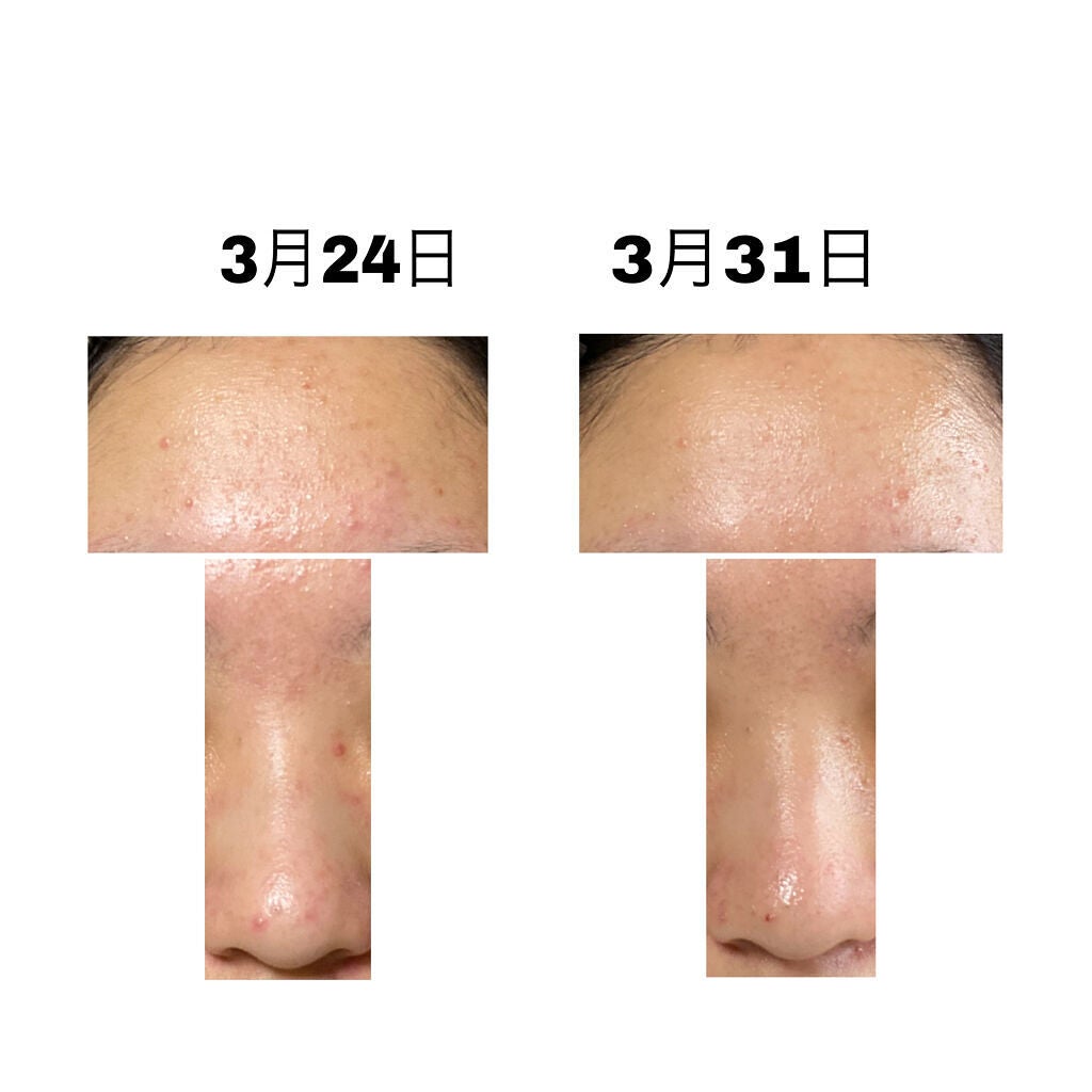 DHC ビタミンCハードカプセル/DHC/美容サプリメントを使ったクチコミ(3枚目)